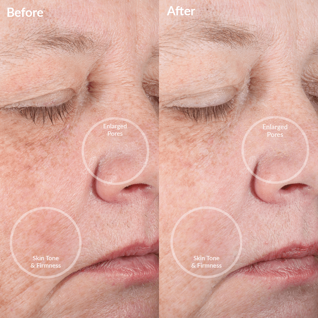 4002-CreamJ? Before and Afters of the PMD Clean Pro Jade
