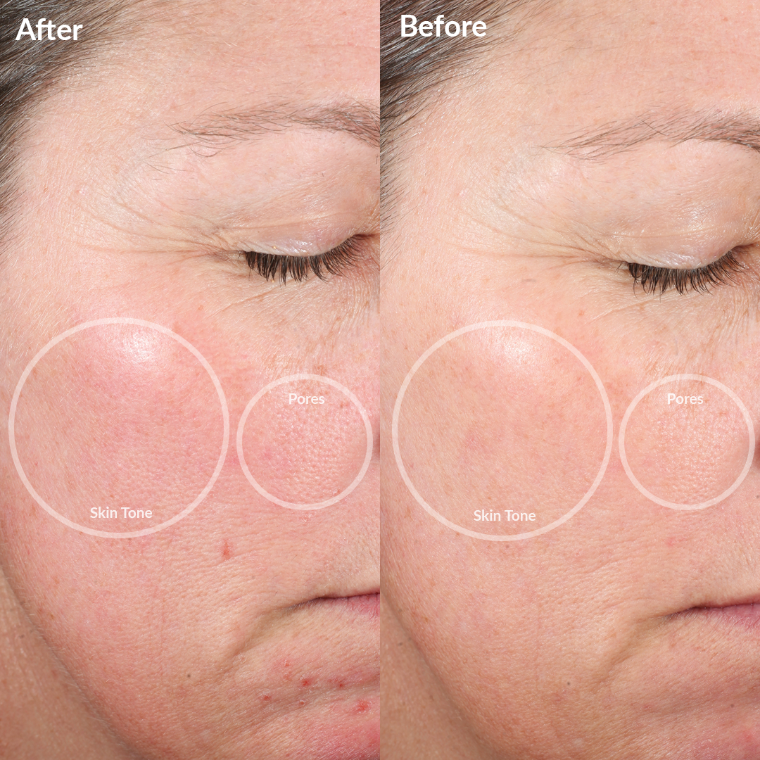 Personal Microderm Elite Pro