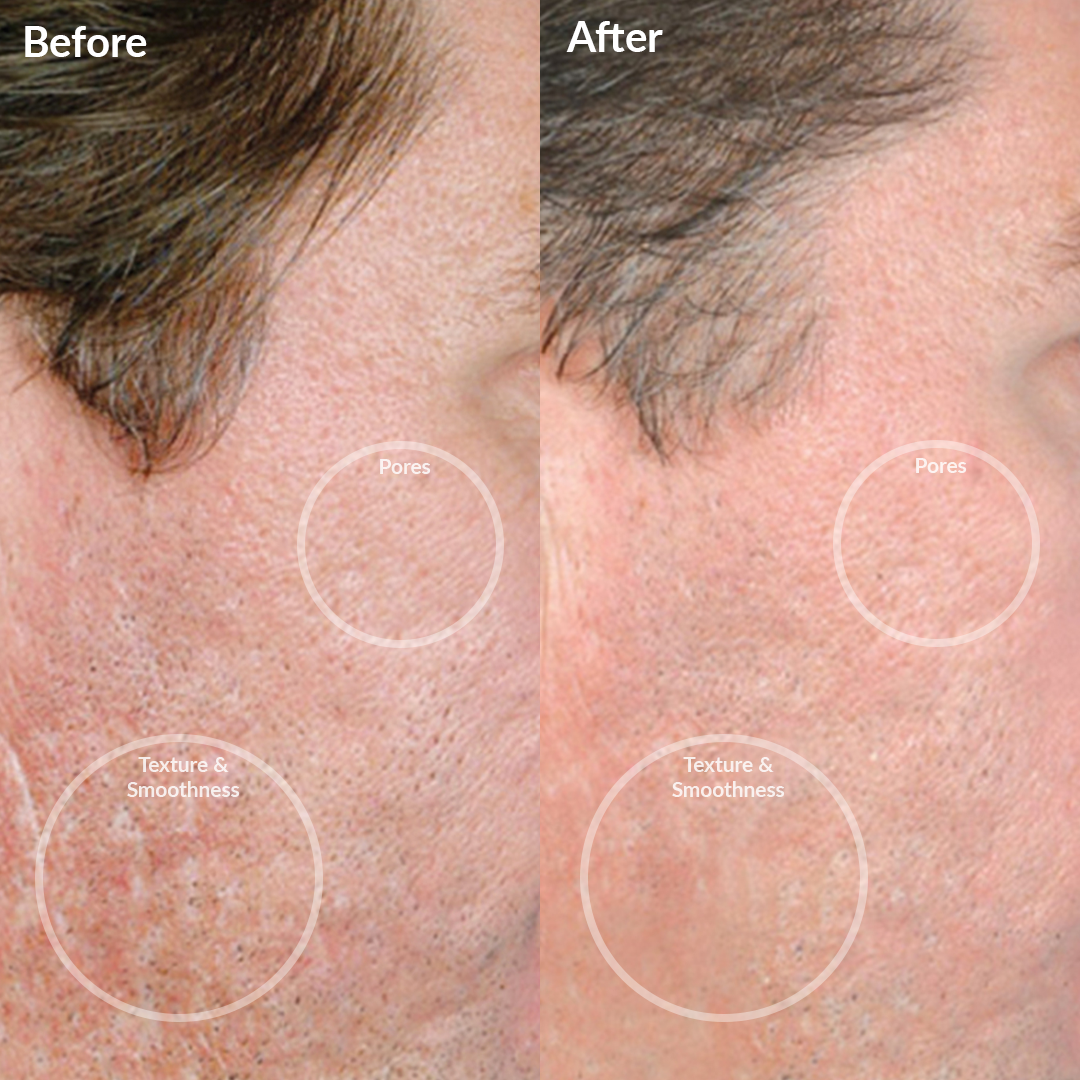 Personal Microderm Man