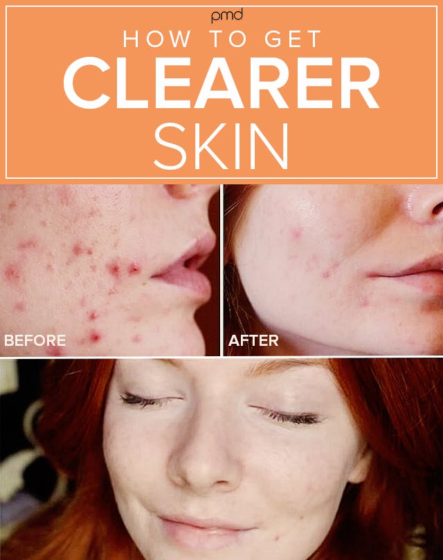 How To Get Clear Skin with before and after photos