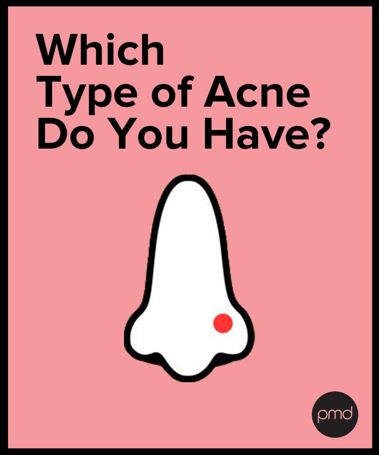 Which Type of Acne Do You Have?