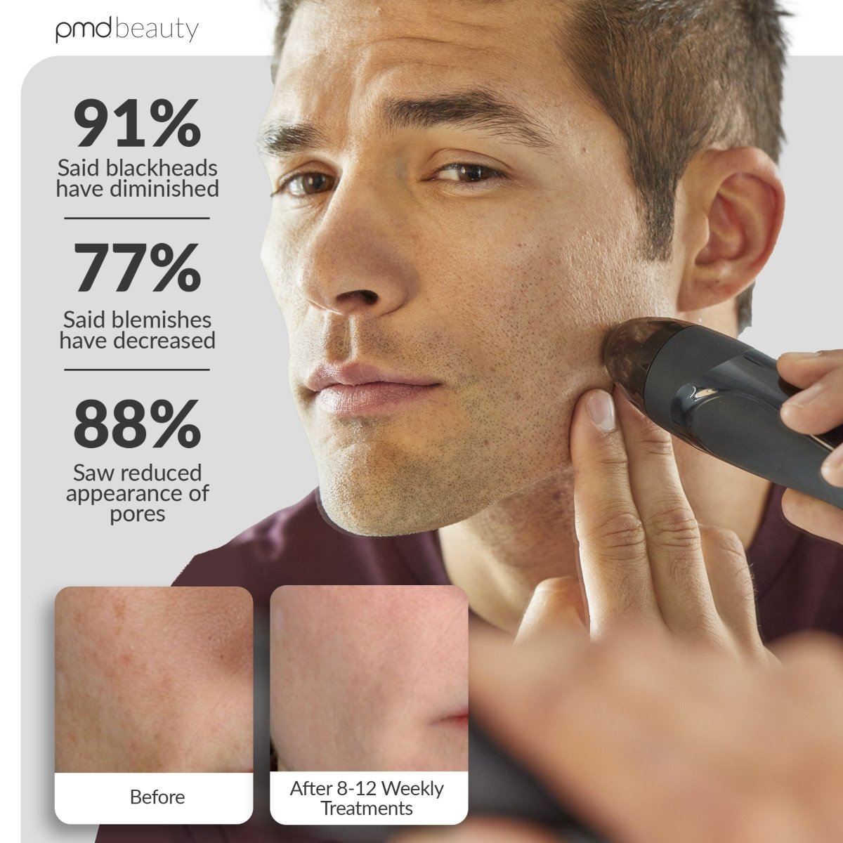 Personal Microderm Elite Pro
