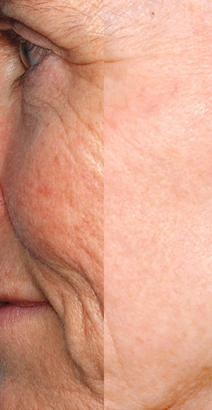 Proven Performance: Before and after image of a lady's cheek