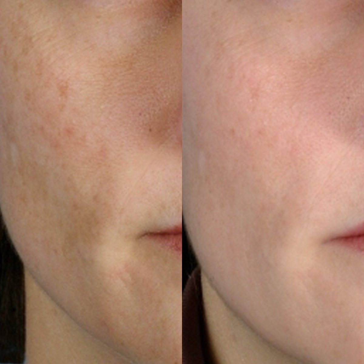 Personal Microderm Classic AU