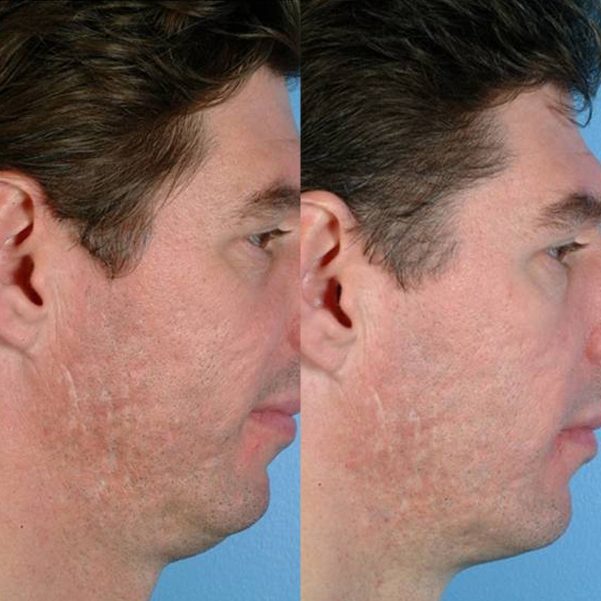 Personal Microderm Pro - Black AU