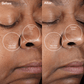 4000-PINK?Before and After Showing Results of the PMD Clean Mini