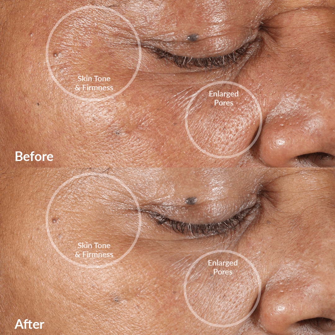4002-Berry?Before and After Image with Results